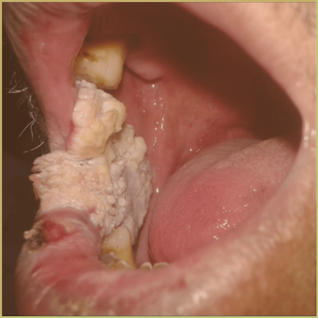 Proliferative Verrucous Leukoplakia 1 1024x1024 1