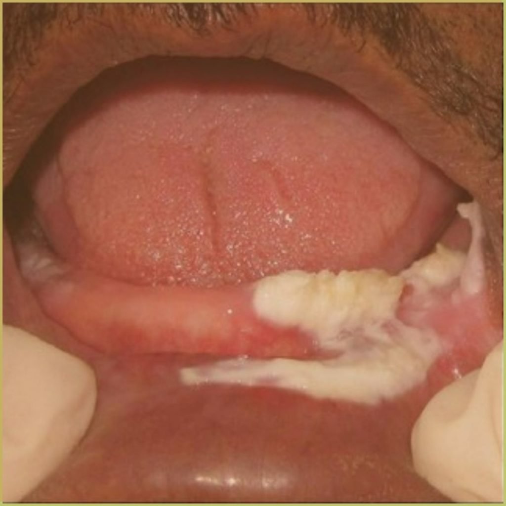 Proliferative Verrucous Leukoplakia 4 1 1024x1024 1