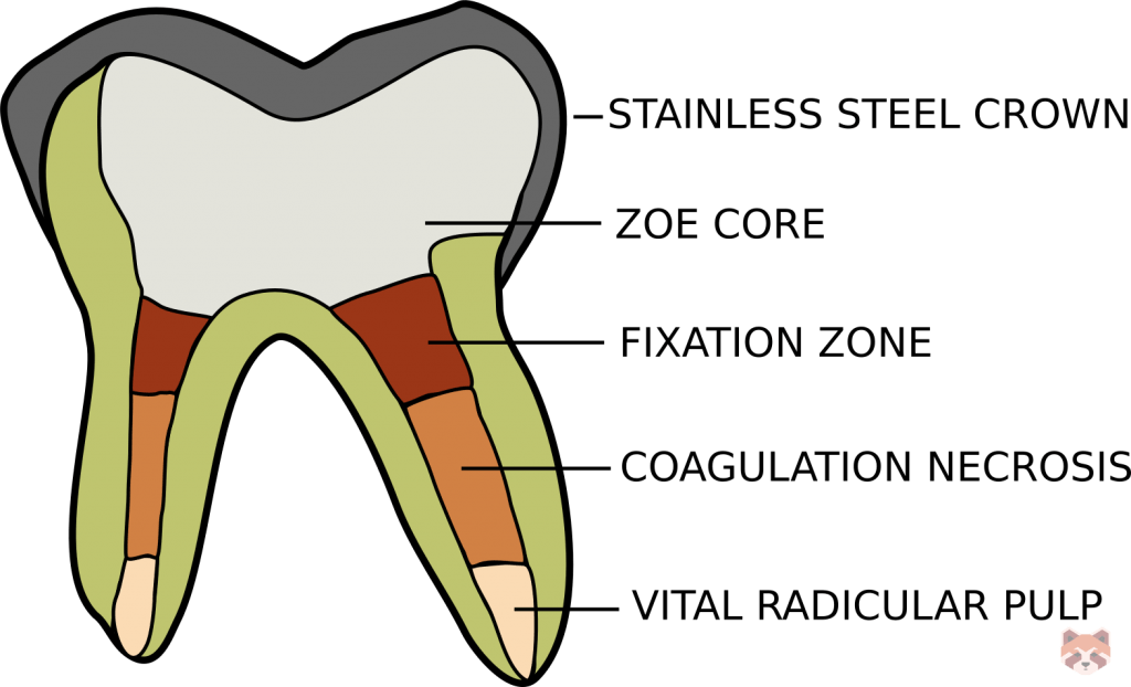 Pulp tissue zones in a formocresol pulptomy 1024x622 1