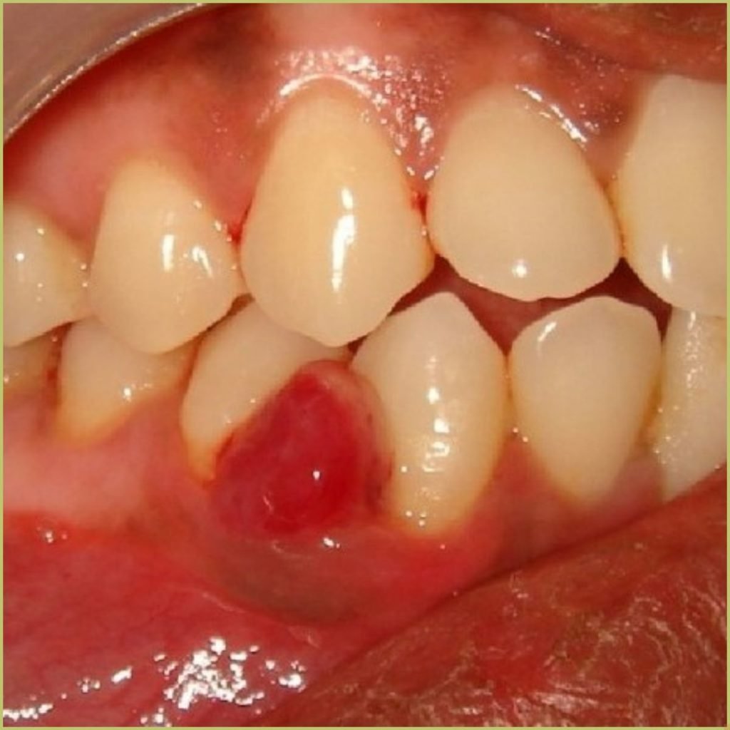 Pyogenic Granuloma 1 1024x1024 1