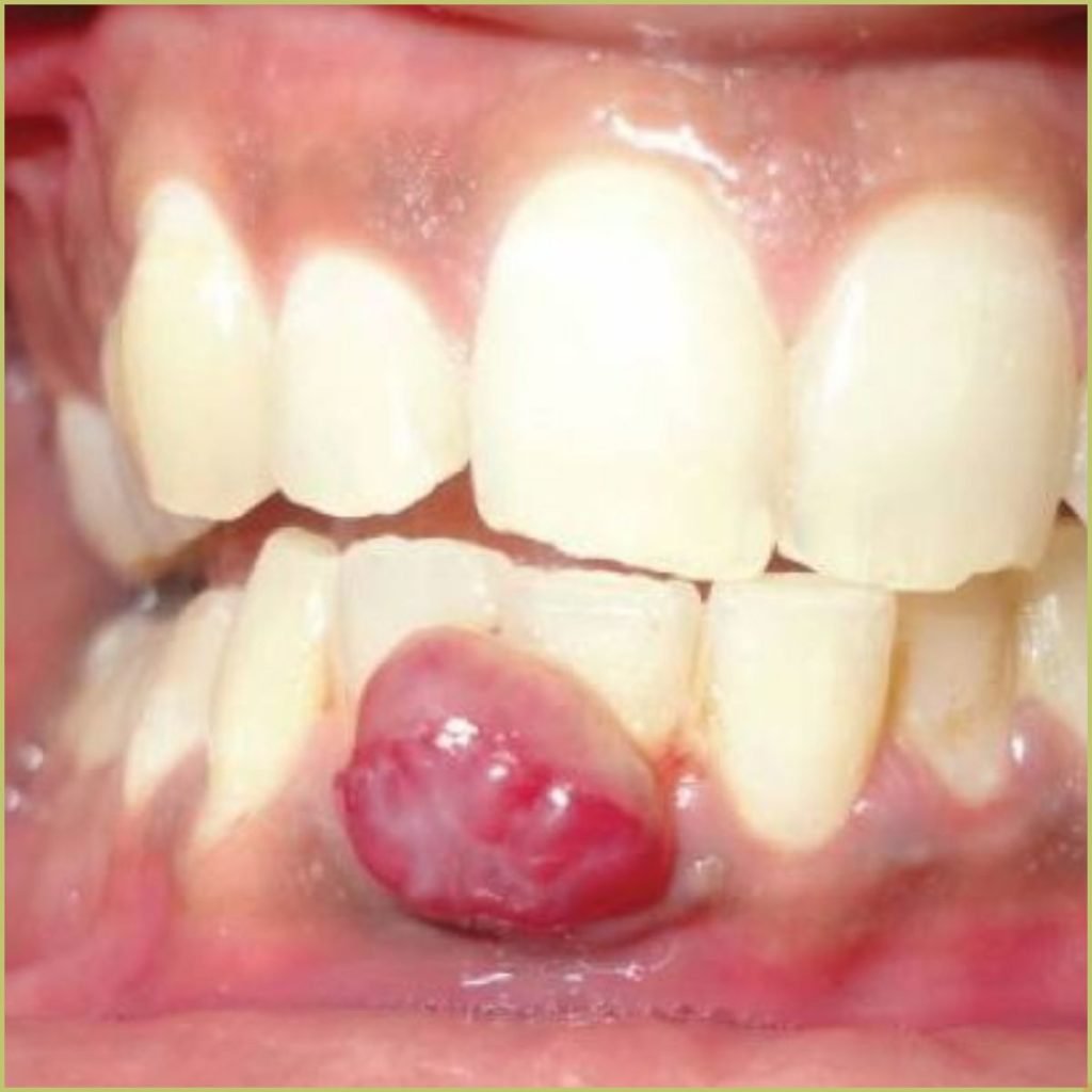 Pyogenic Granuloma 2 1024x1024 1