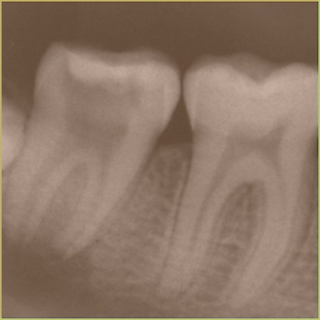 Radicular Cysts 1 1024x1024 1