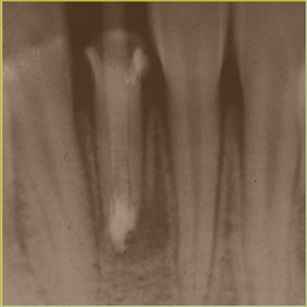 Radicular Cysts 2 1024x1024 1