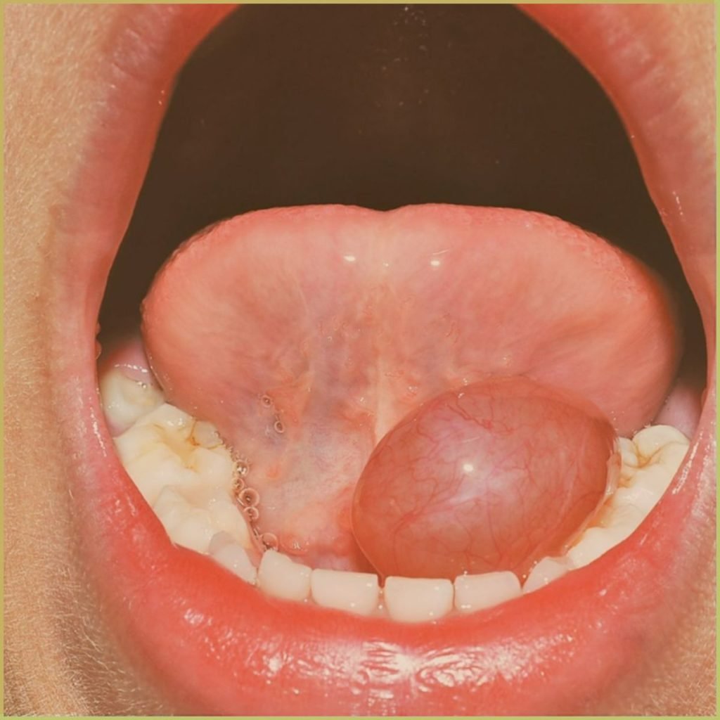 Ranula 1 1024x1024 1