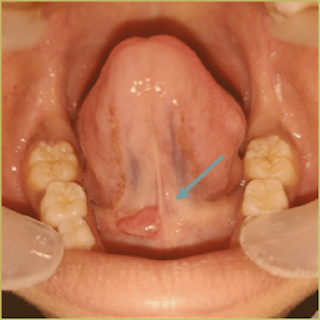 Ranula 4 1024x1024 1