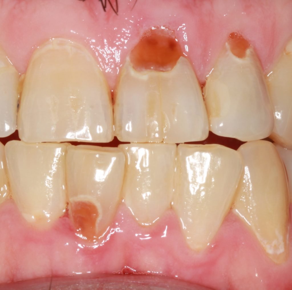 Root surface caries cropped 1024x1016 1