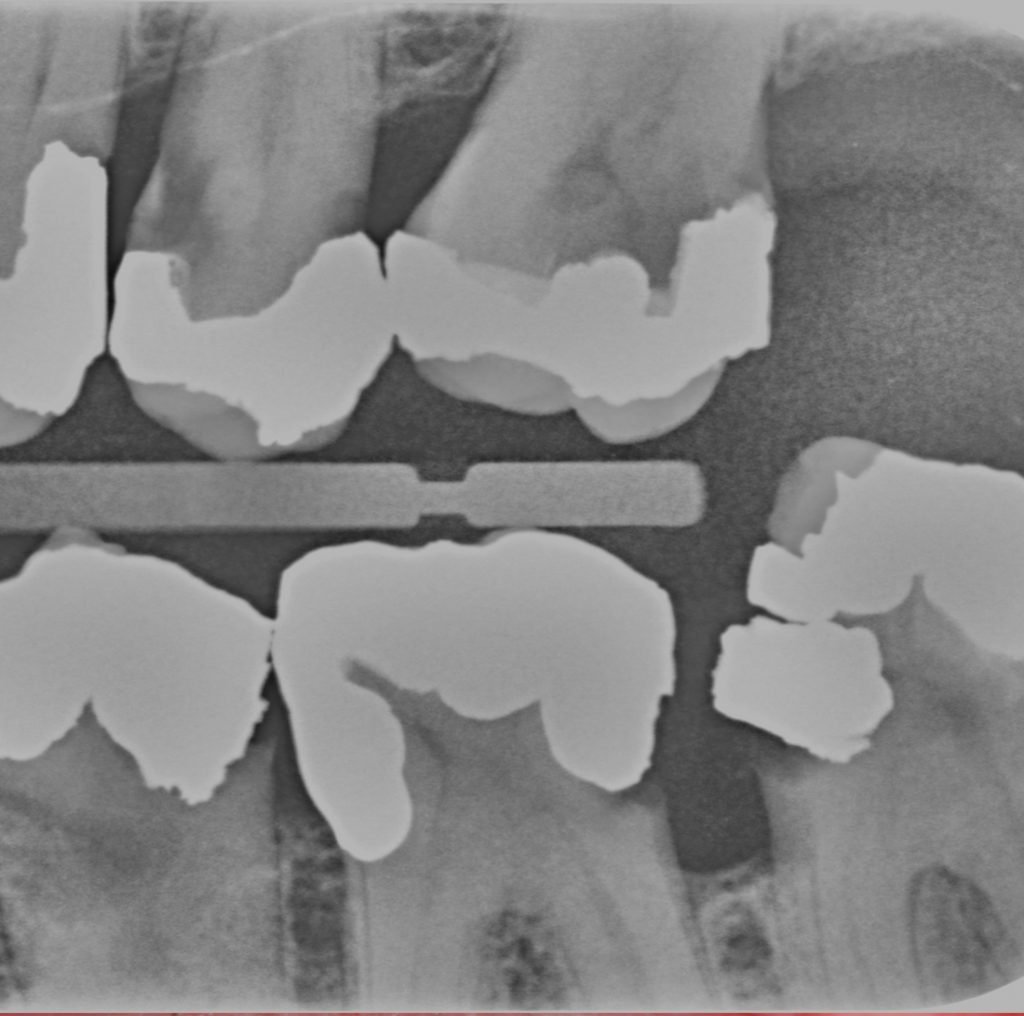 Root surface caries cropped 2 1024x1016 1