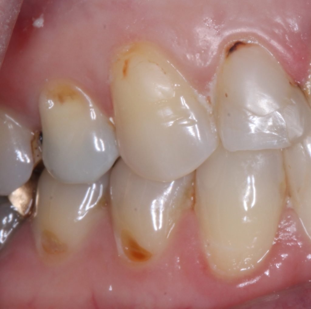 Root surface caries cropped 3 1 1024x1016 1