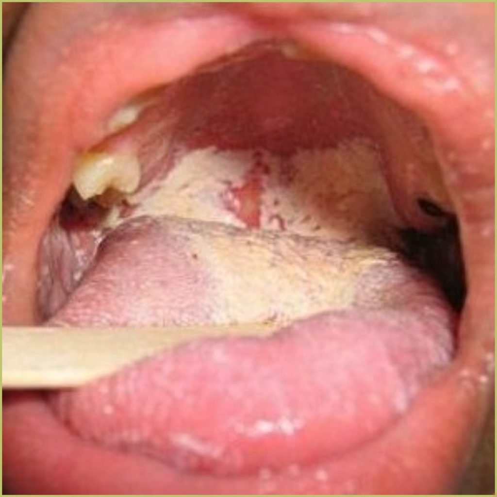 Sjogrens Syndrome 1 1 1 1024x1024 1