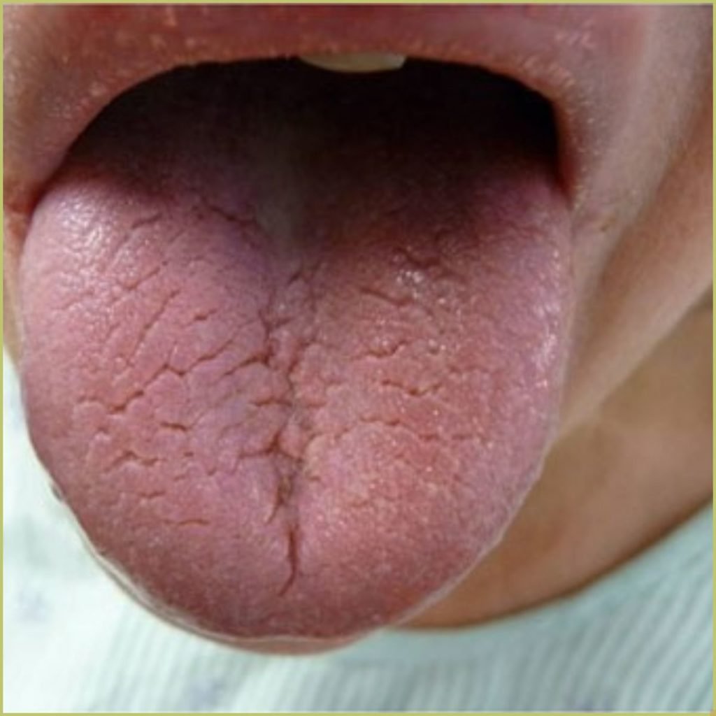 Sjogrens Syndrome 2 2 1024x1024 1