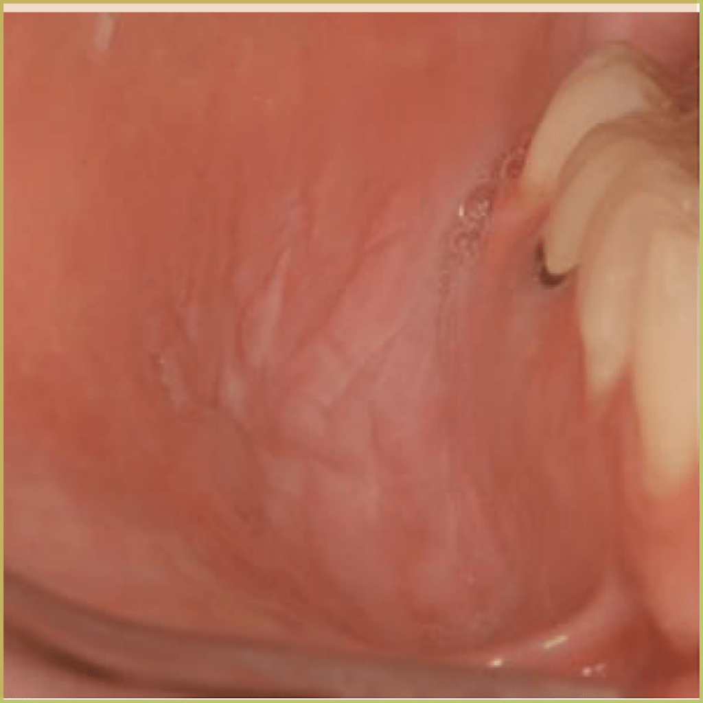 Smokeless tobacco keratosis 1 1024x1024 1