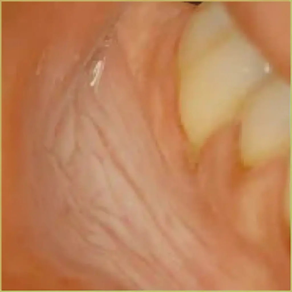 Smokeless tobacco keratosis