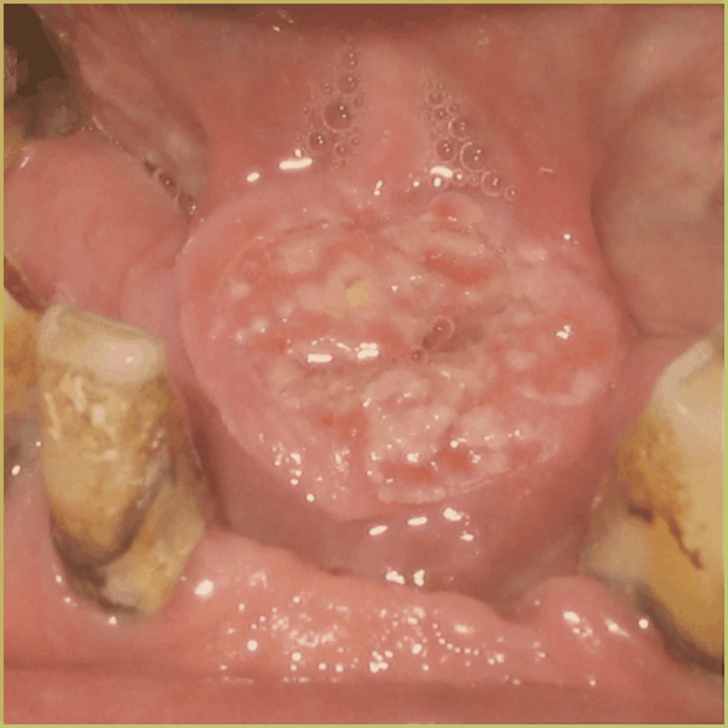 Squamous Cell Carcinoma 2 1024x1024 1