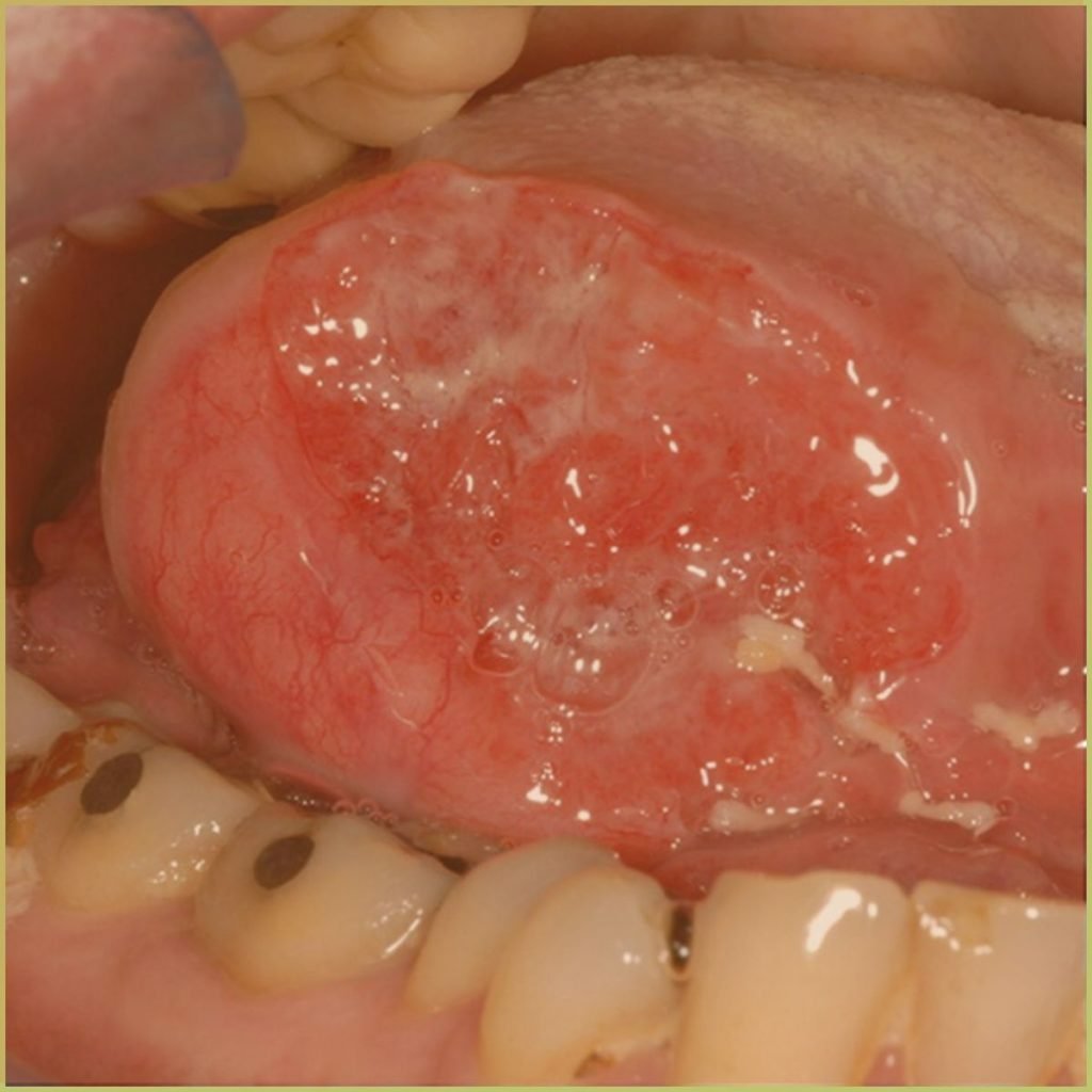 Squamous Cell Carcinoma 3 1024x1024 1