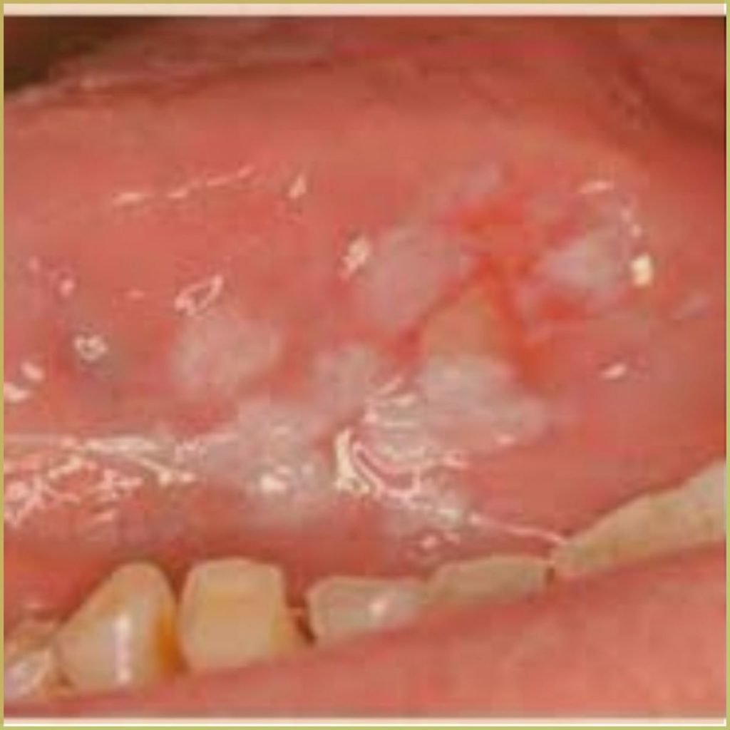 Squamous Cell Carcinoma 4 1024x1024 1