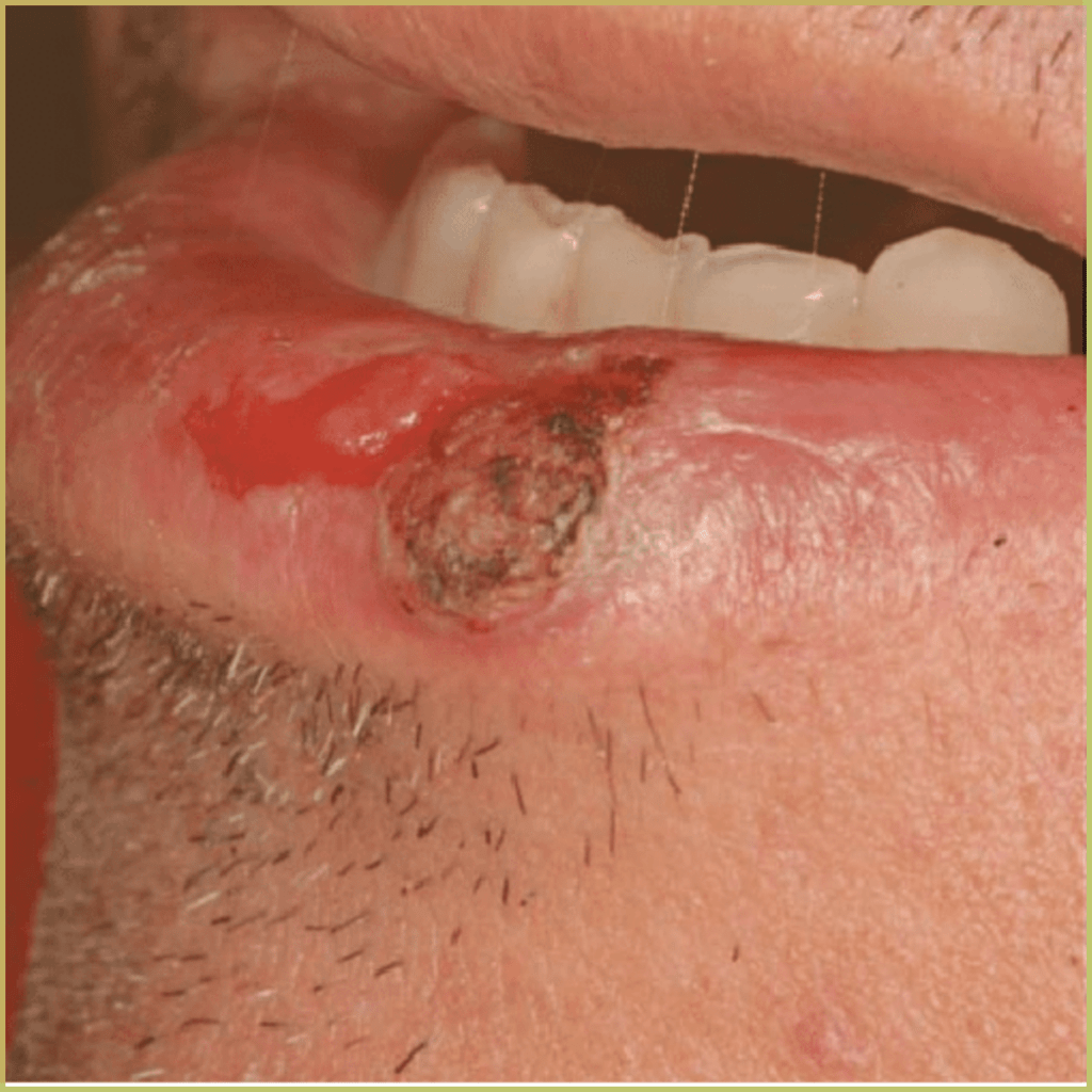 Squamous Cell Carcinoma 5 1024x1024 1