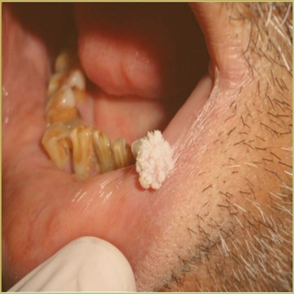 Squamous Papilloma 1 1024x1024 1