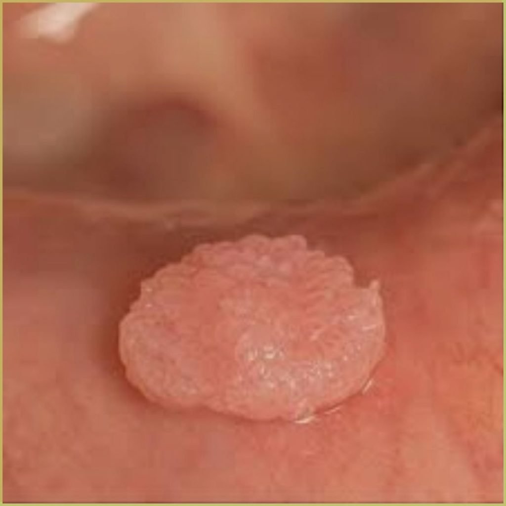 Squamous Papilloma 4 1024x1024 1