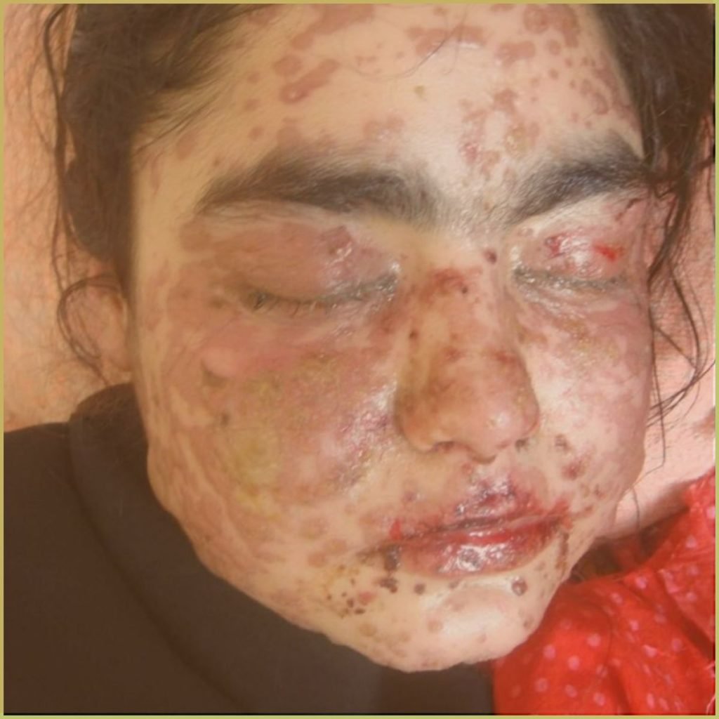 Stevens Johnson syndrome 1 1024x1024 1