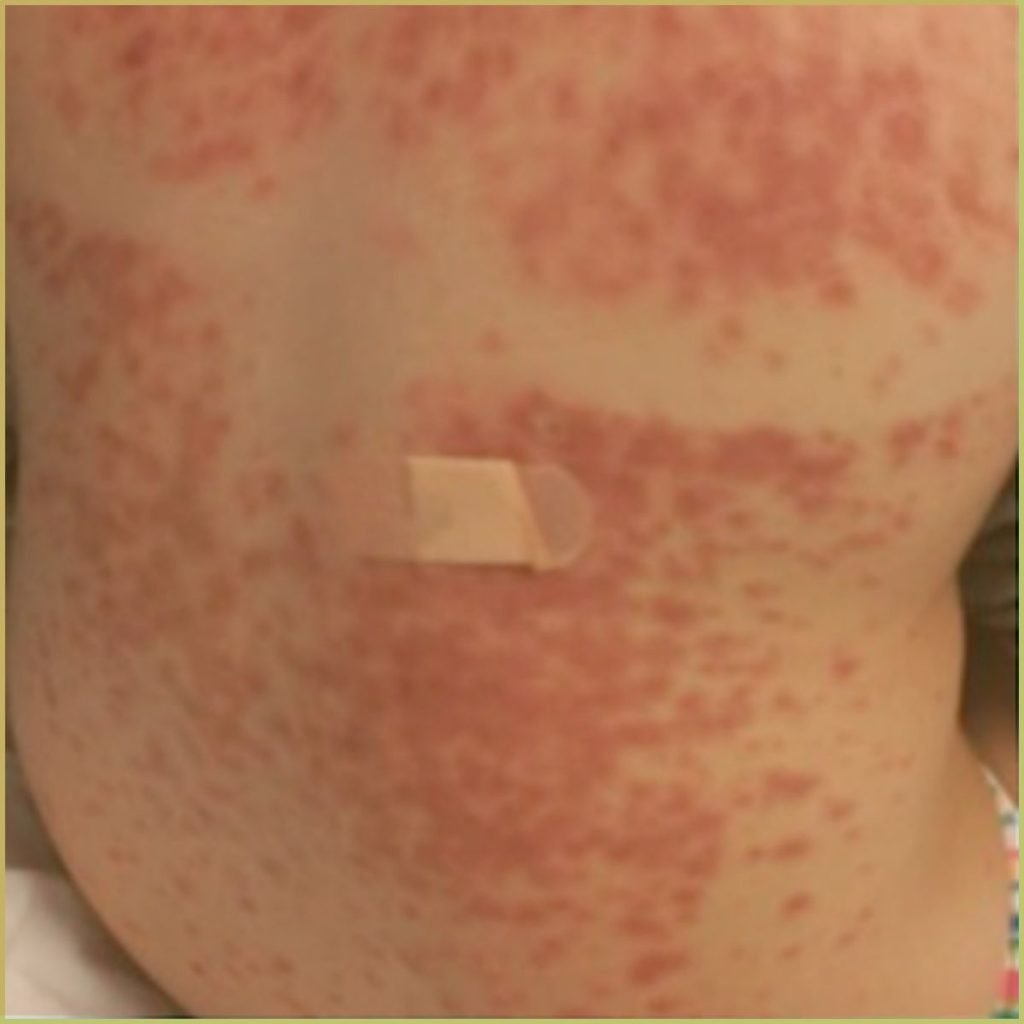 Stevens Johnson syndrome 2 1024x1024 1