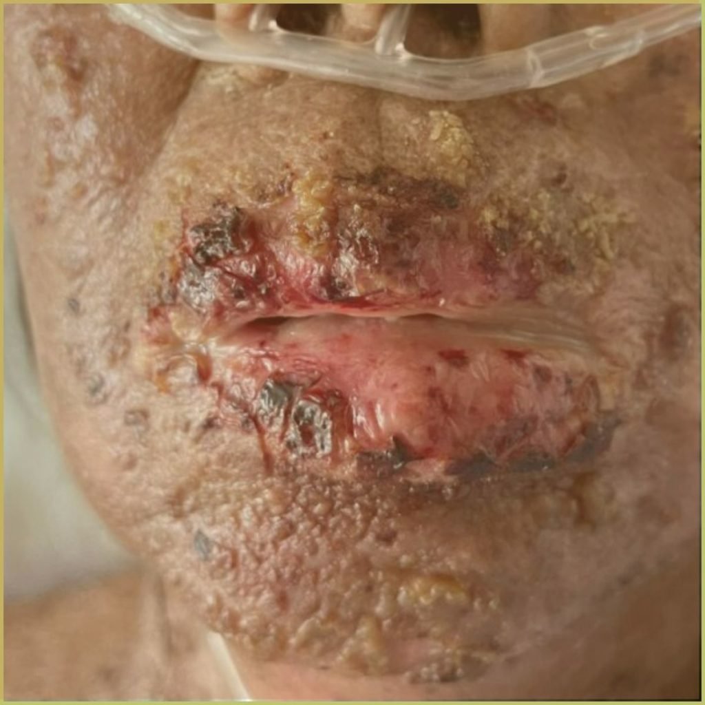 Stevens Johnson syndrome 3 1024x1024 1