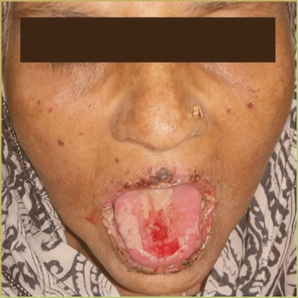 Stevens Johnson syndrome 4 1024x1024 1