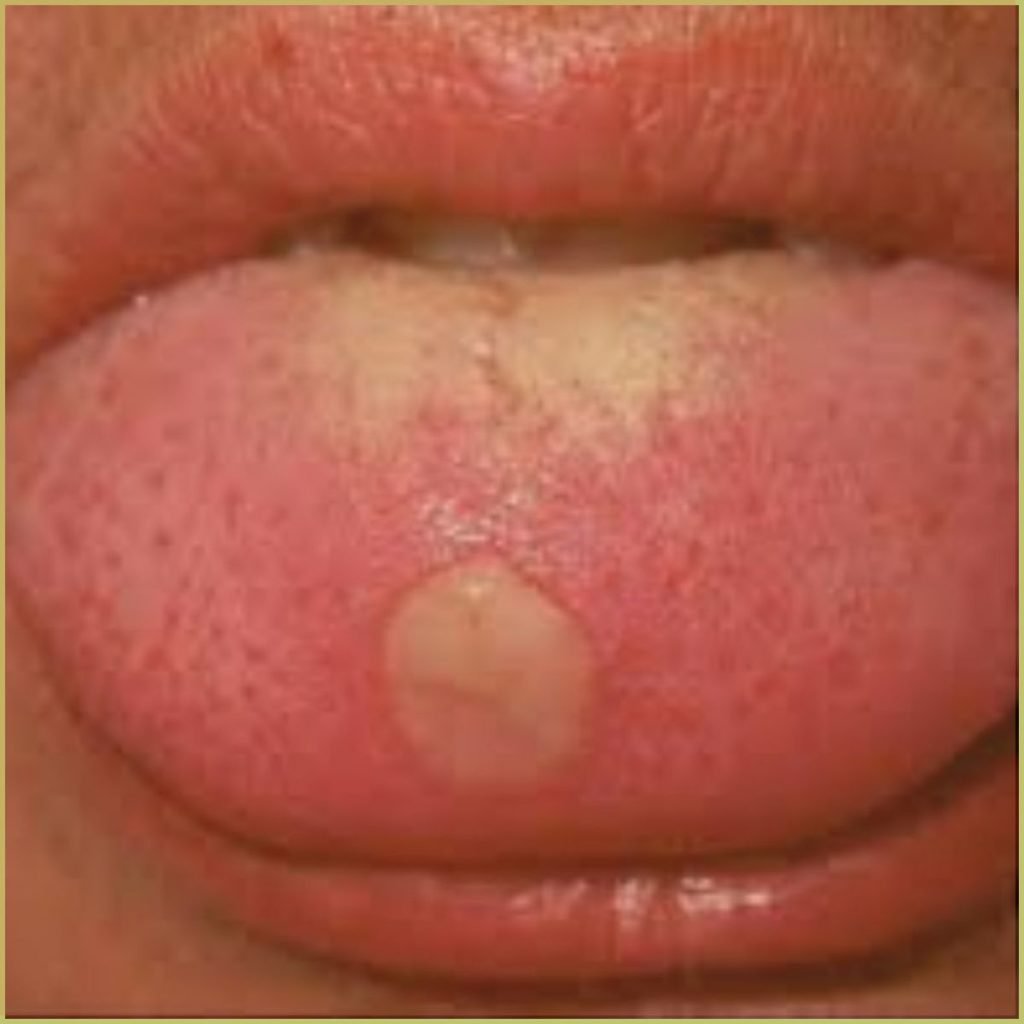 Syphilis 2 1024x1024 1