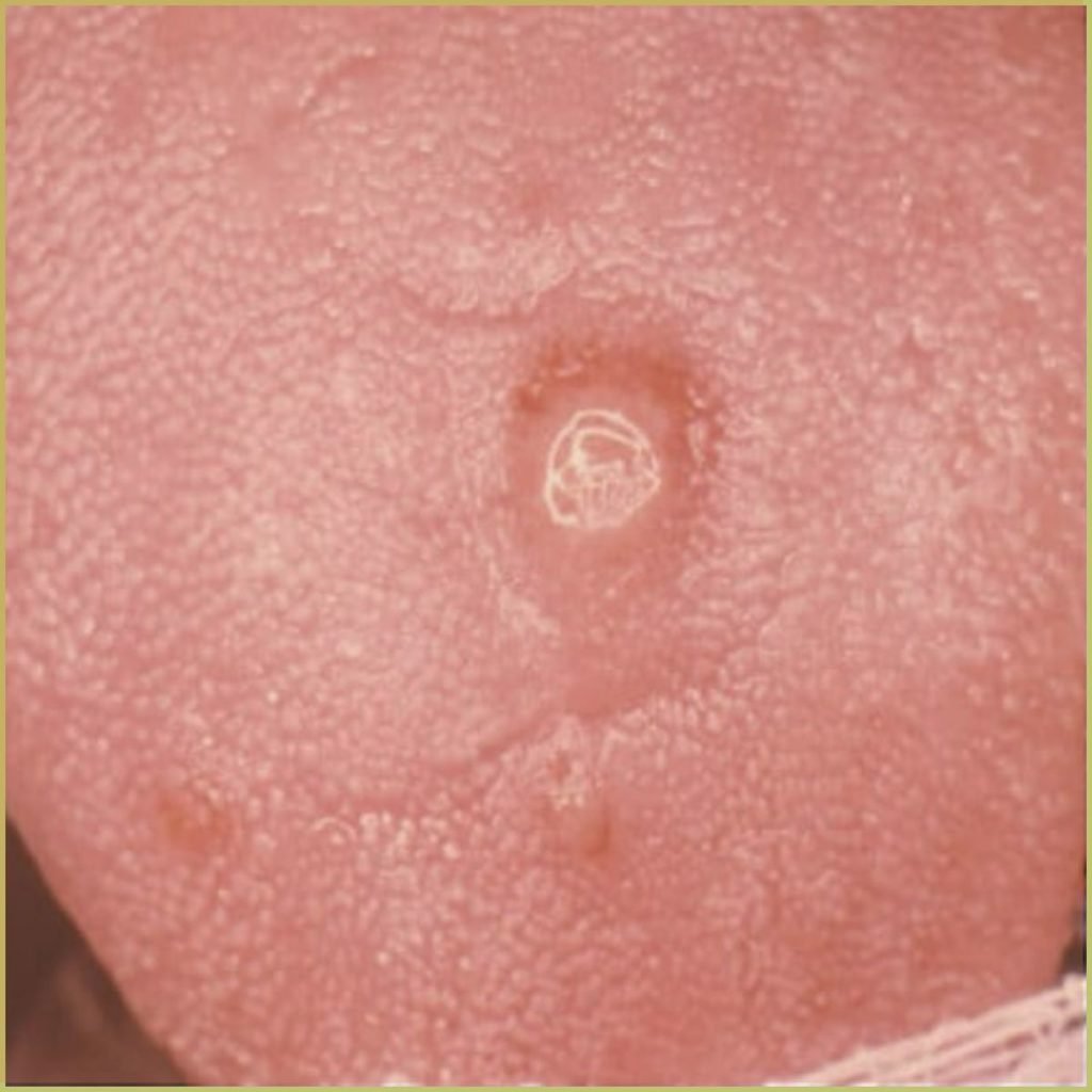 Syphilis 3 1024x1024 1