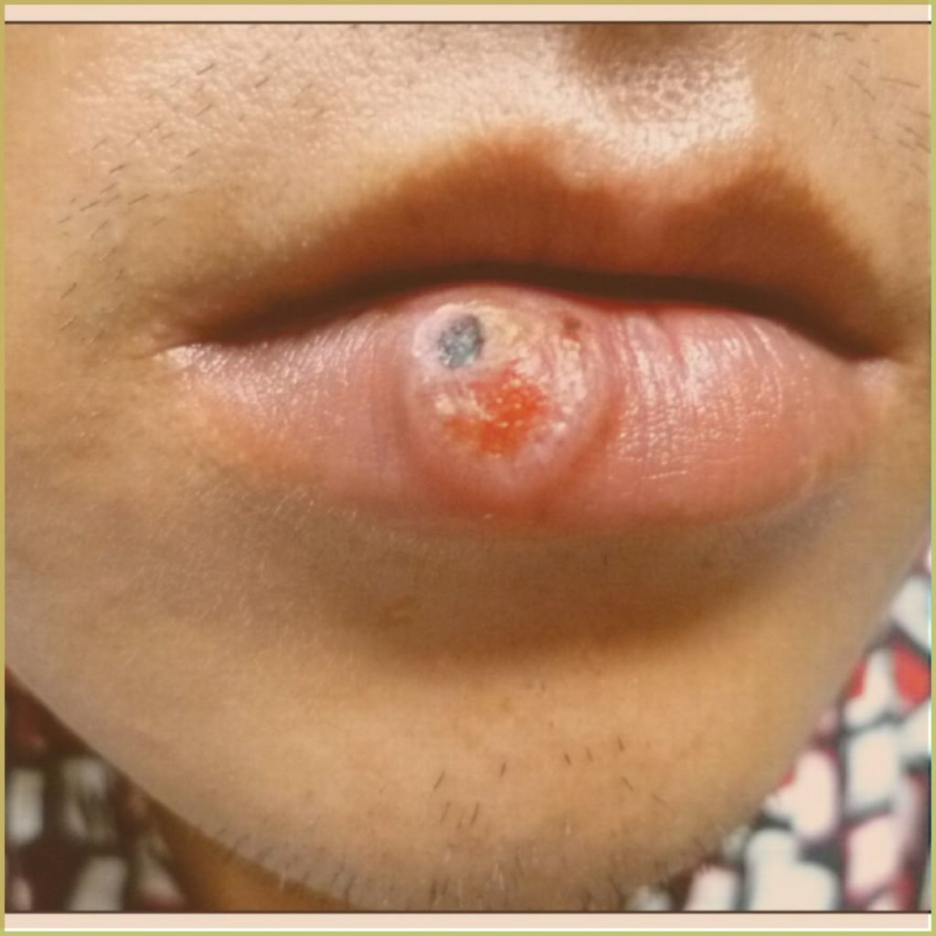 Syphilis 4 1024x1024 1