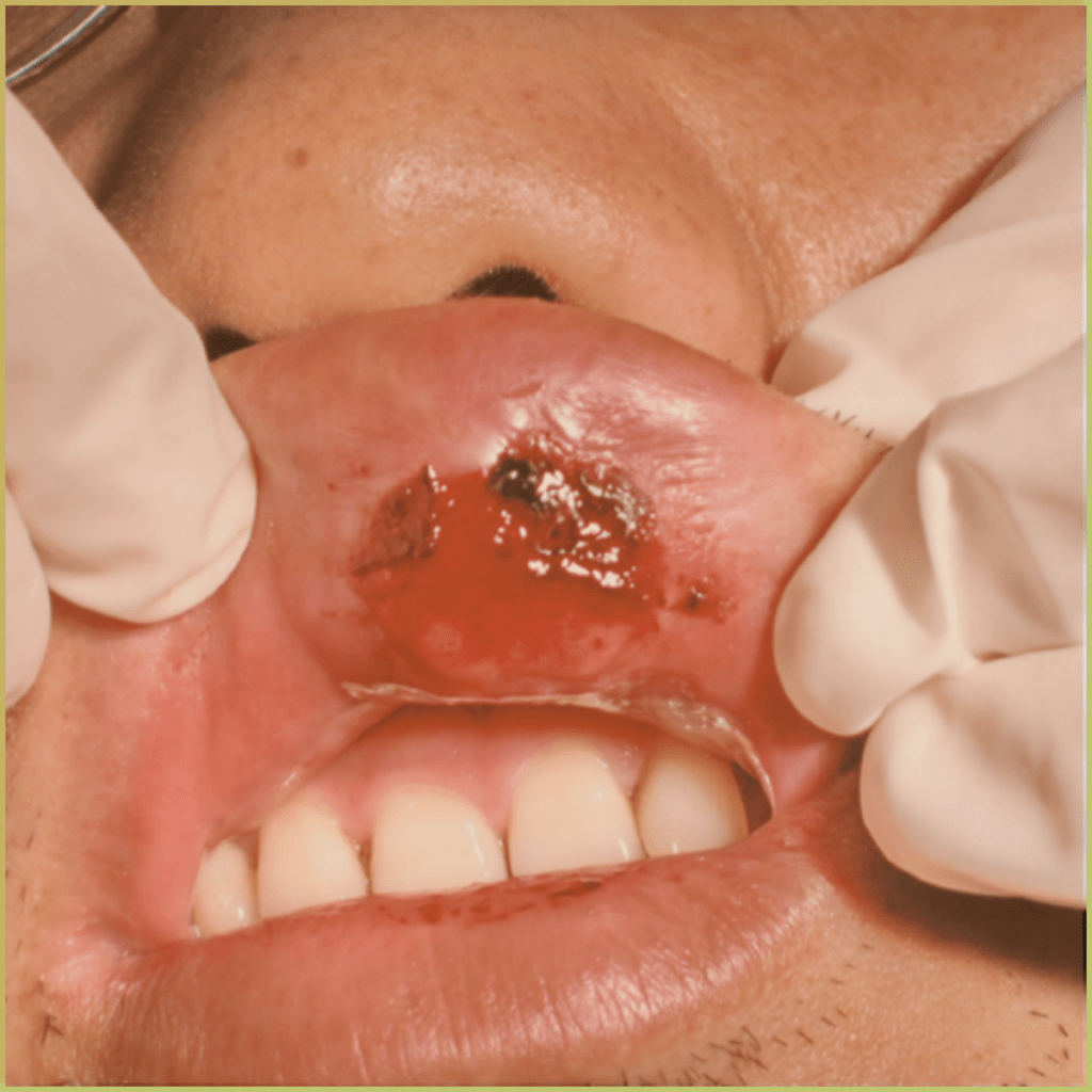 Syphilis 5 1024x1024 1