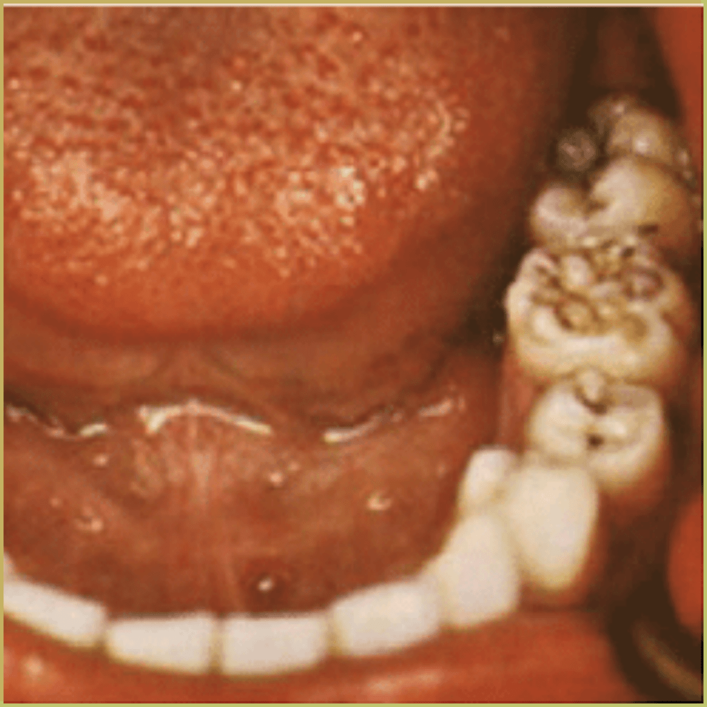 Syphilis 7 1024x1024 1