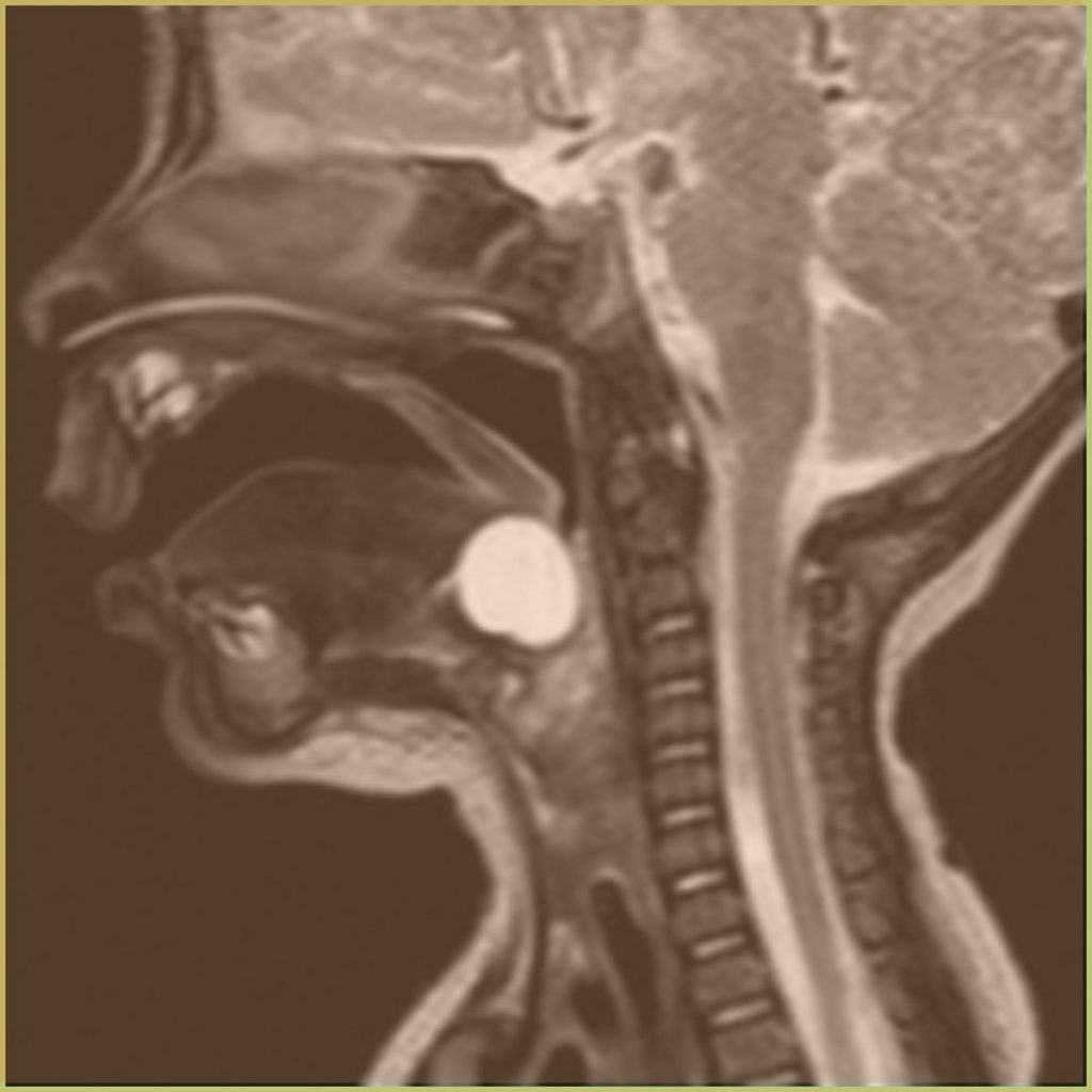 Thyroglossal Duct Cysts 2 1024x1024 1