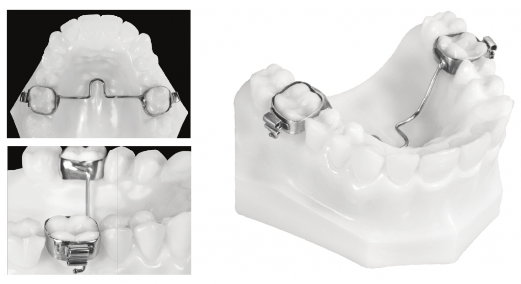 Transpalatal arch TPA 1024x559 1