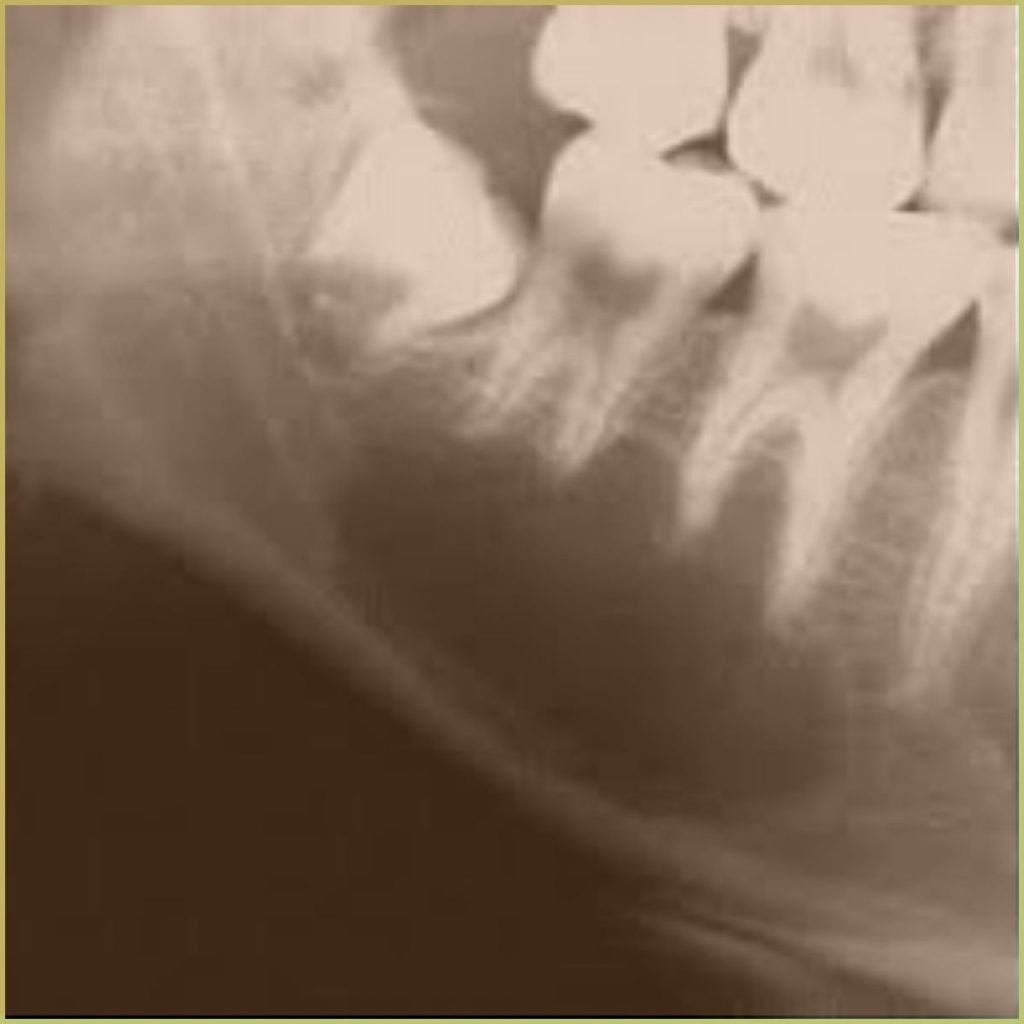 Traumatic Bone Cysts 3 1024x1024 1