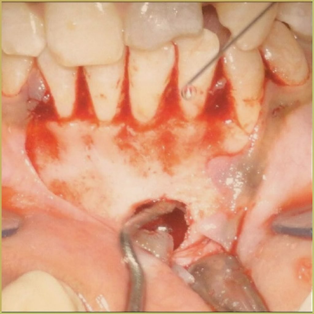 Traumatic Bone Cysts 4 1024x1024 1