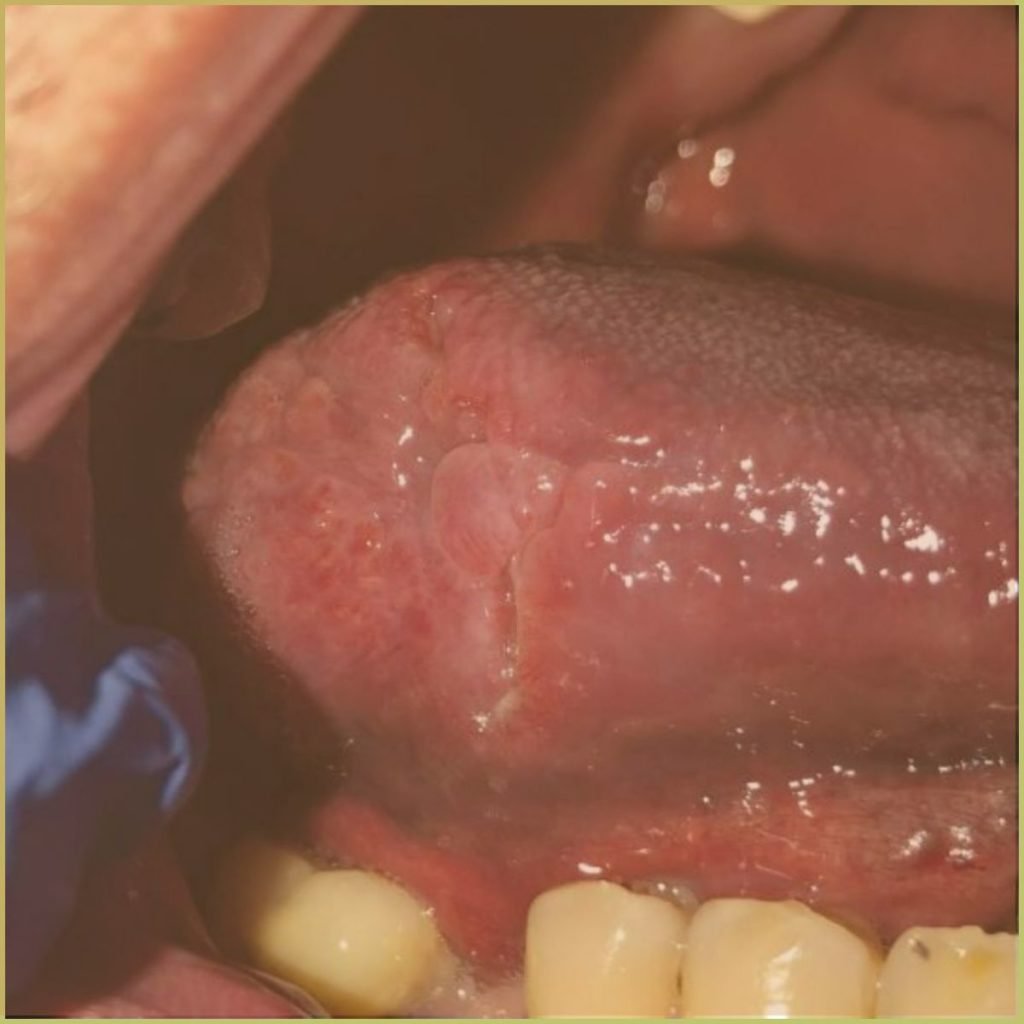 Tuberculosis 1 1024x1024 1