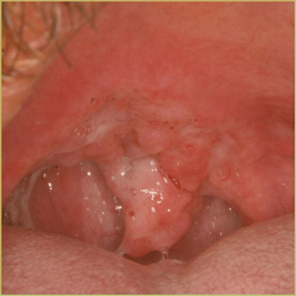 Tuberculosis 4 1 1024x1024 1