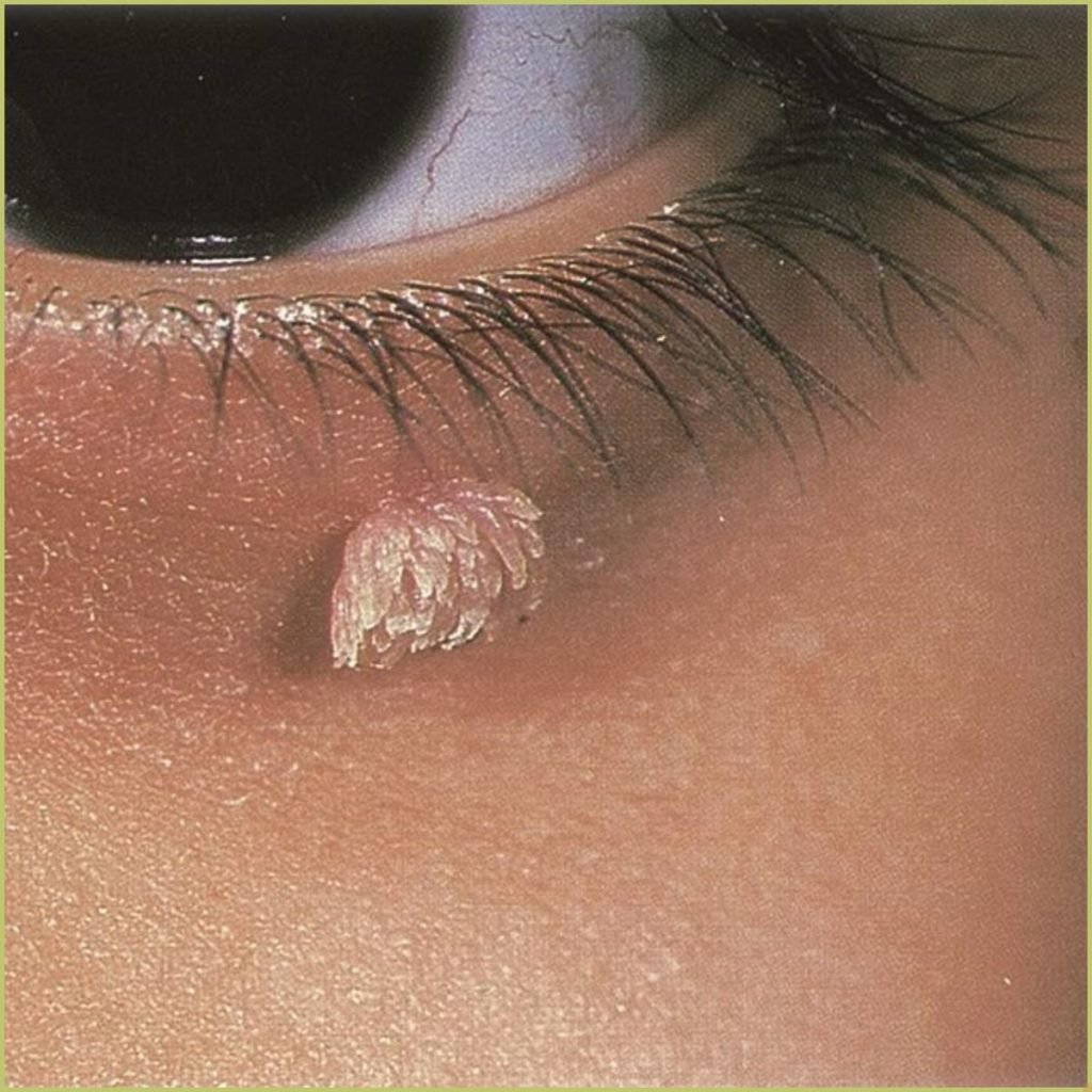 Verruca Vulgaris 2 1024x1024 1