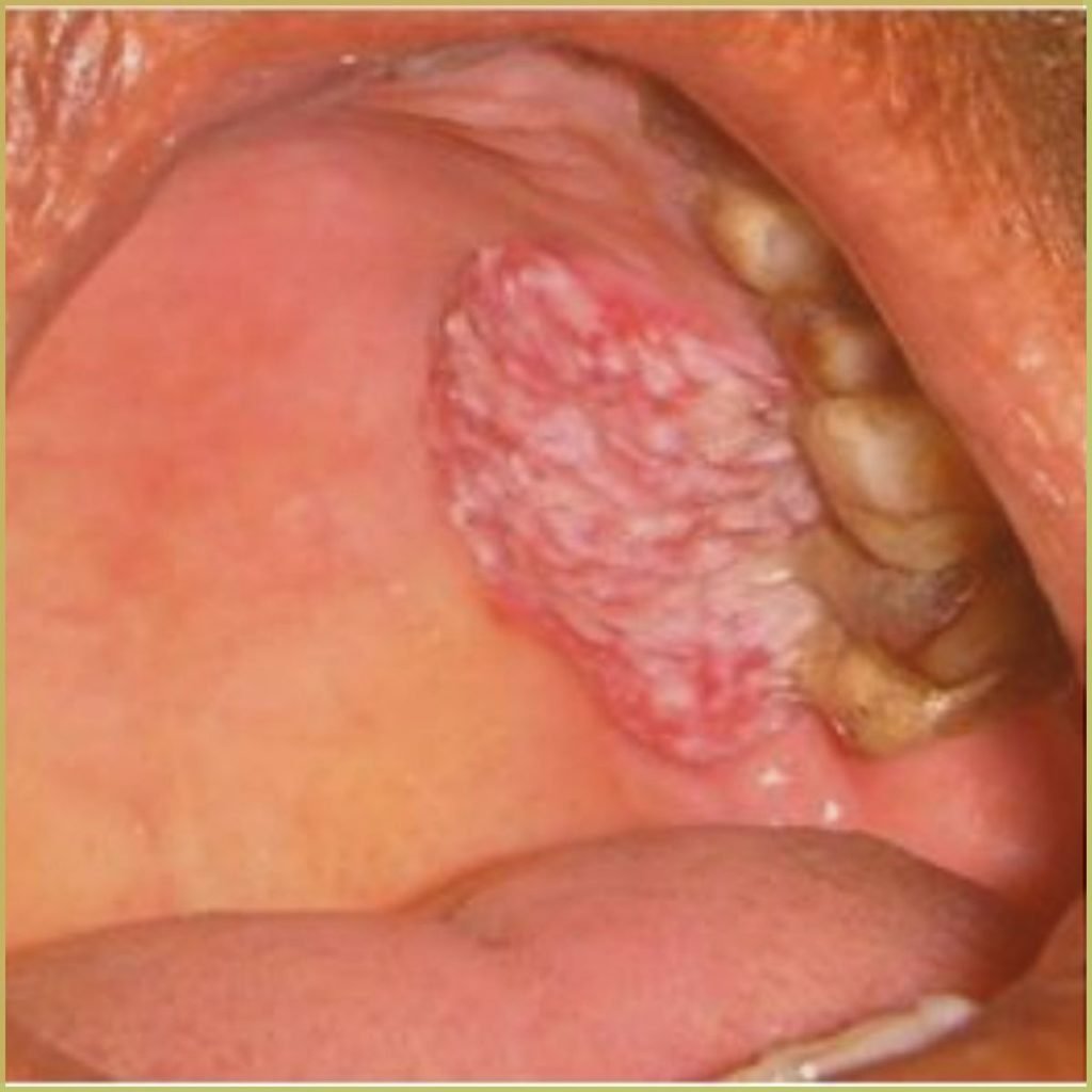 Verrucous Carcinoma 2 1024x1024 1