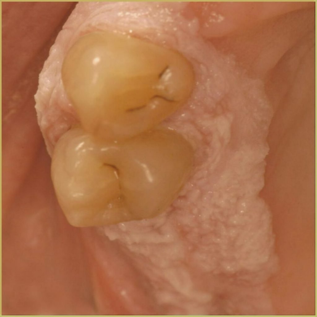 Verrucous Carcinoma 3 1024x1024 1