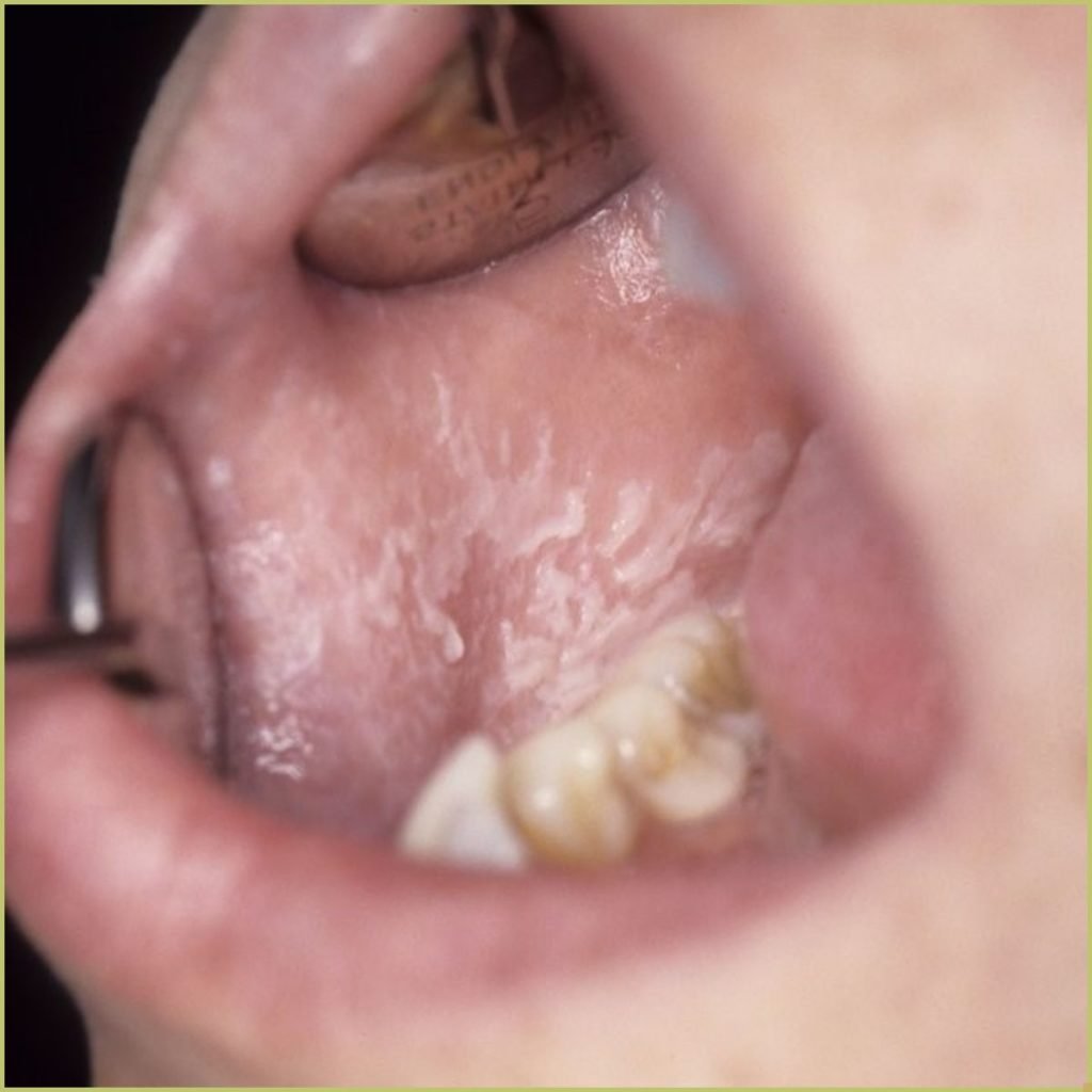 White Sponge Nevus 2 1024x1024 1