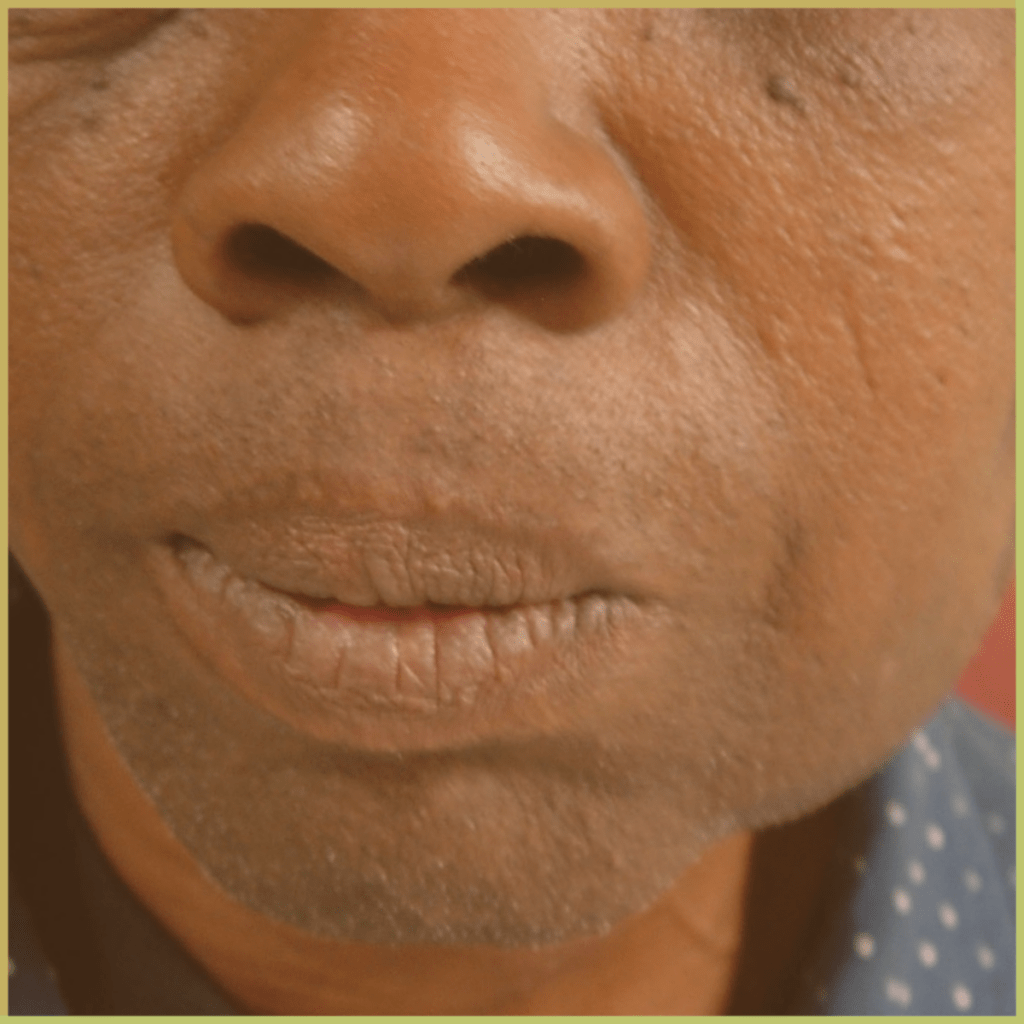 actinomycosis 2 1 1024x1024 1