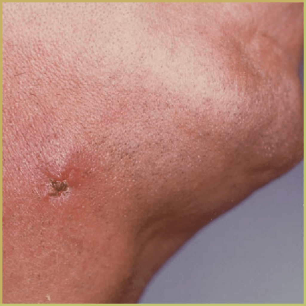 actinomycosis 3 1 1024x1024 1