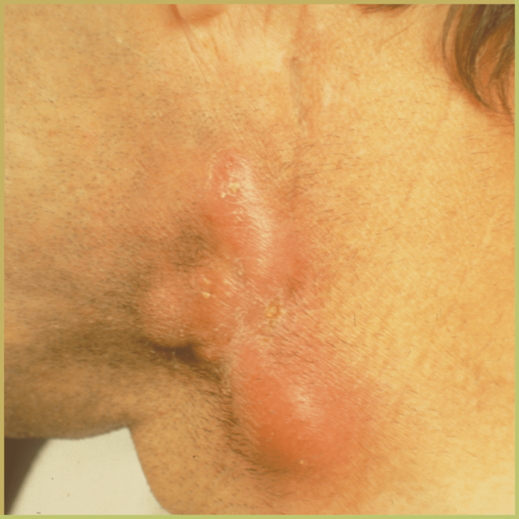 actinomycosis 4 1 1024x1024 1