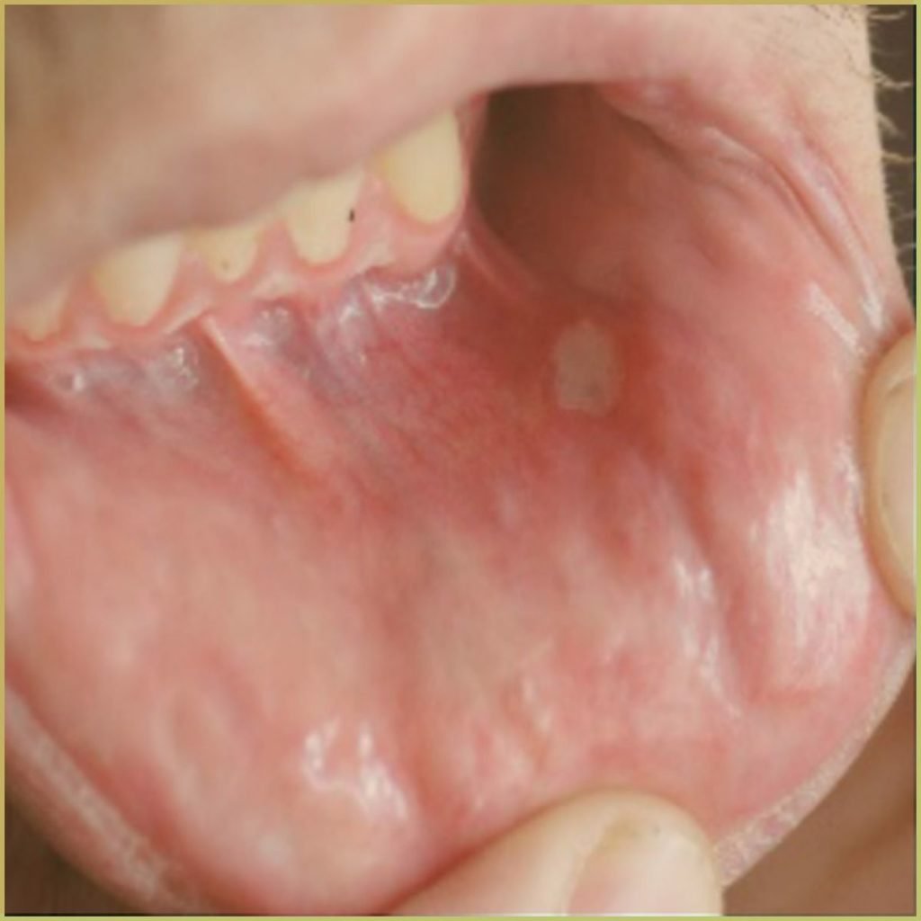 behcets disease 1 1024x1024 1