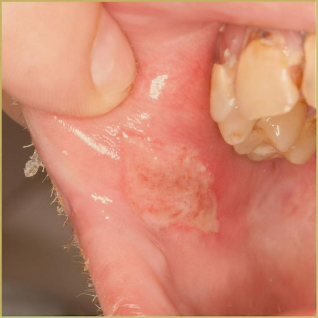 behcets disease 2 1024x1024 1