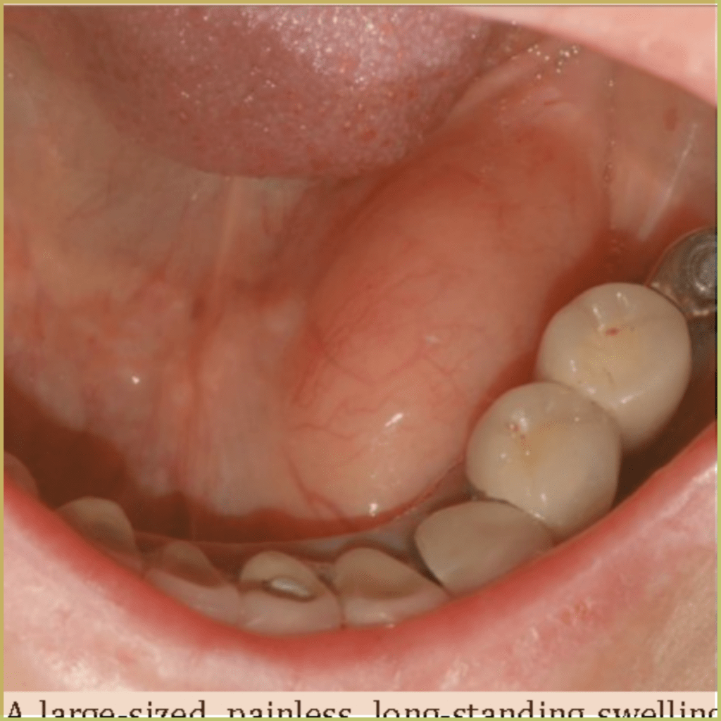 lipoma 2 1024x1024 1