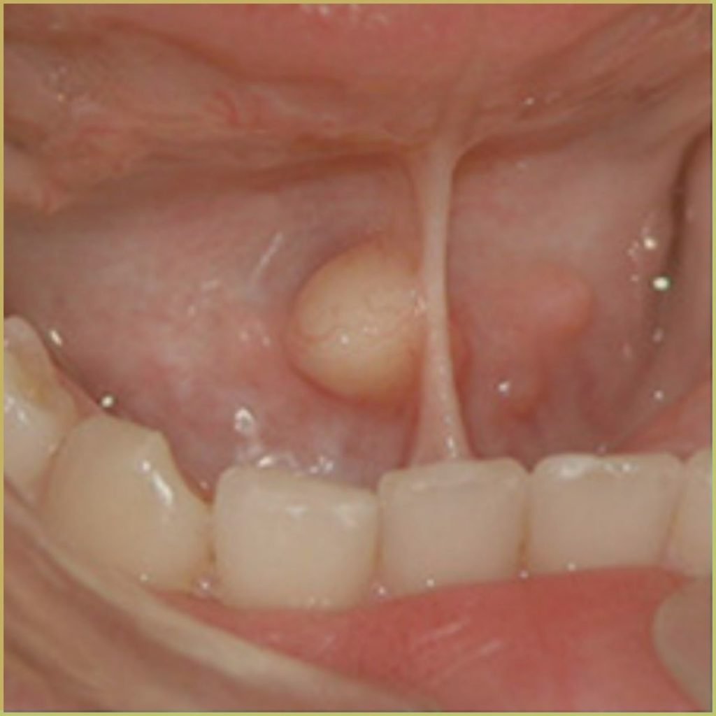 lipoma 3 1024x1024 1