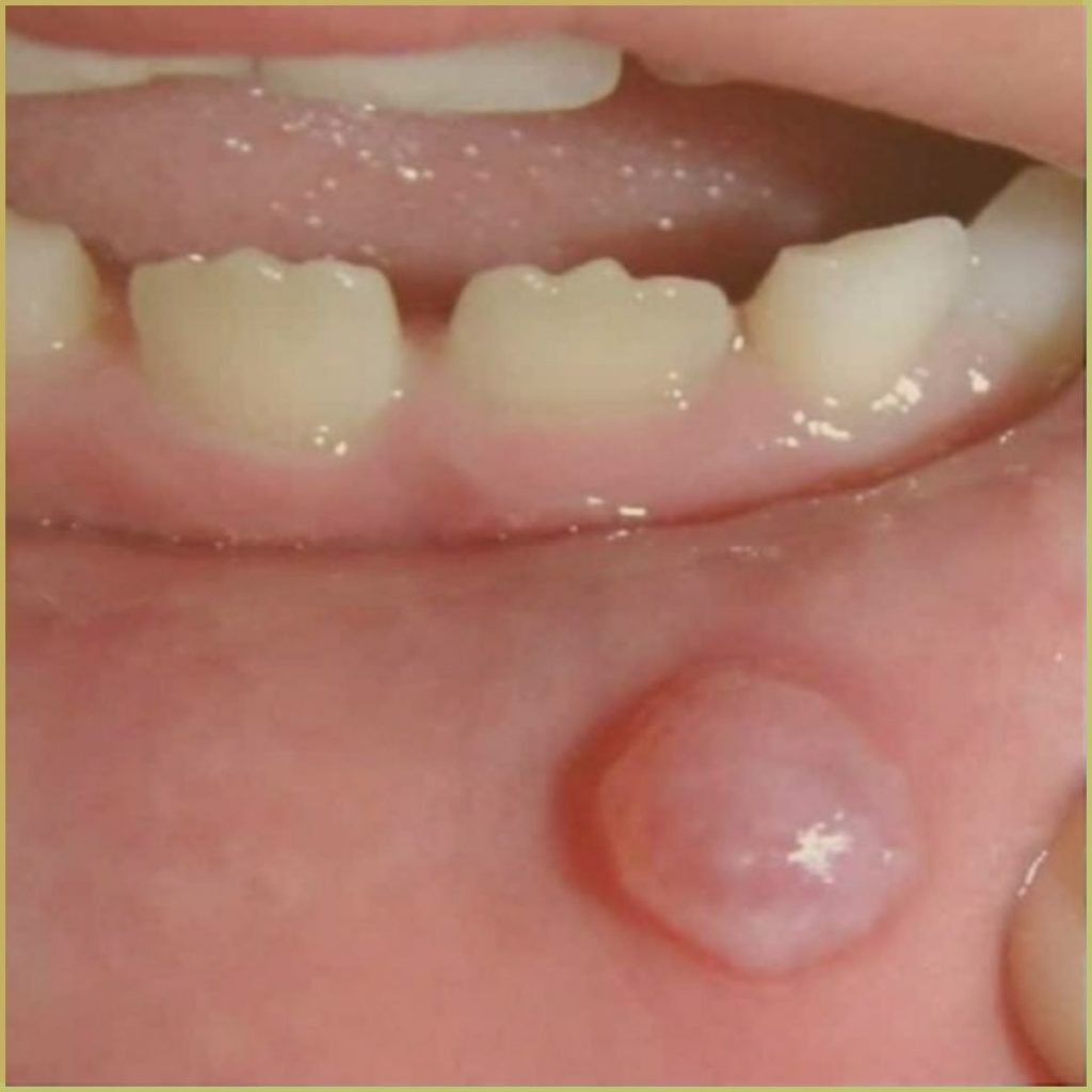 mucocele 2 1024x1024 1