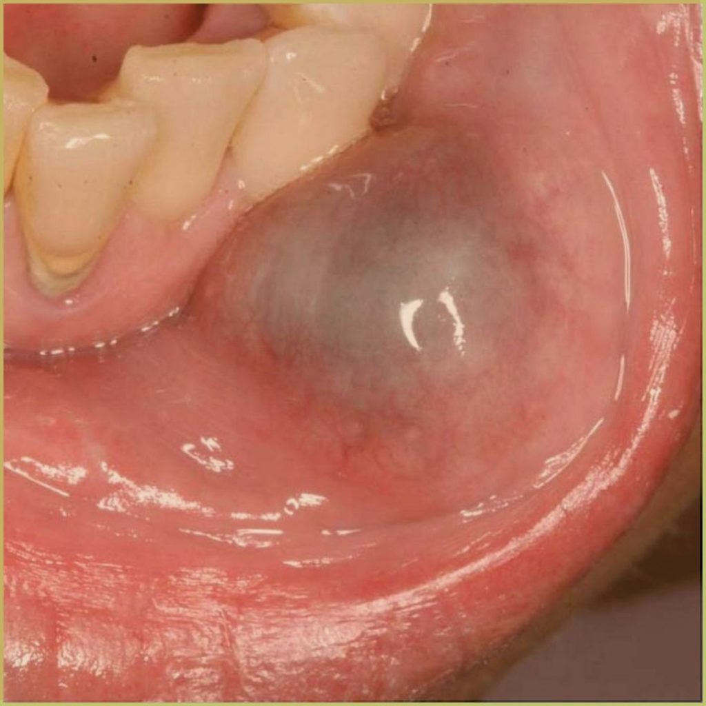 mucocele 3 1024x1024 1